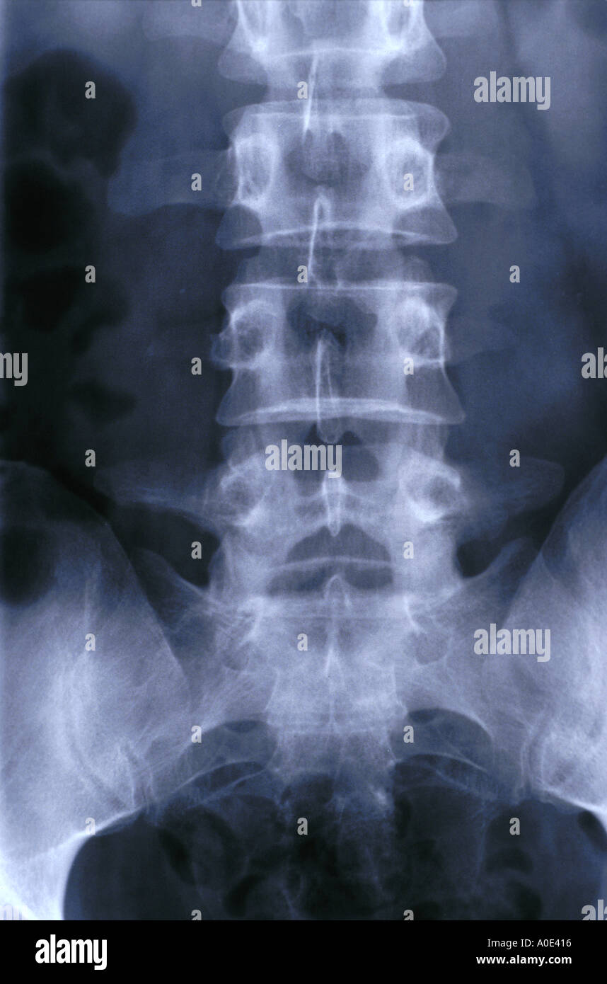 Wirbelsäule-X-ray Stockfoto