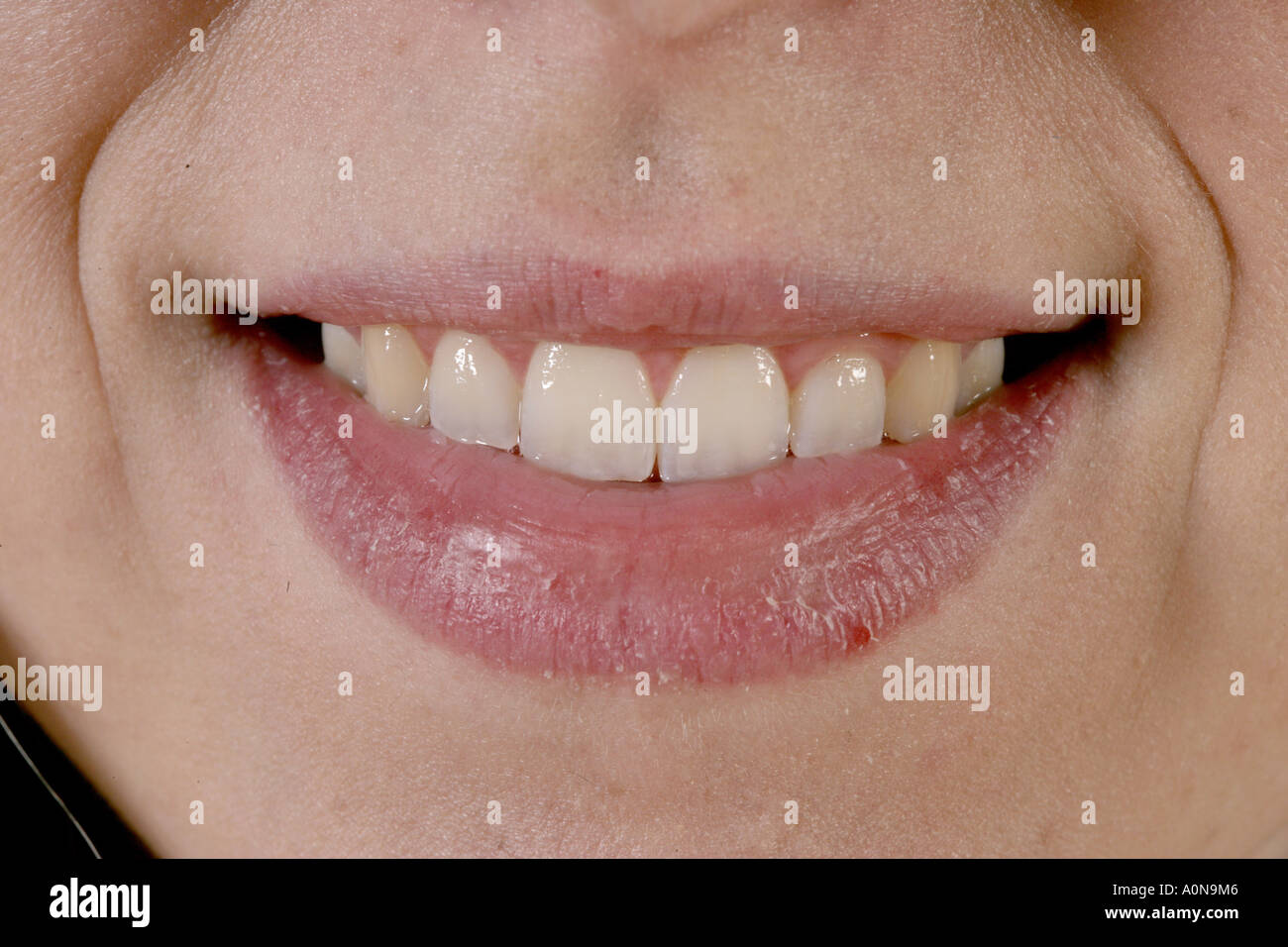 Nahaufnahme einer Frau Lächeln mit rissigen Lippen. Stockfoto