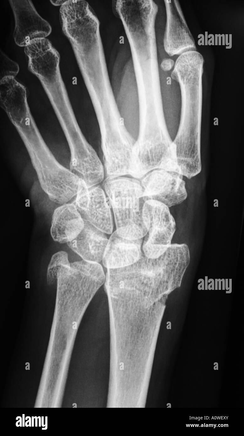 X-Ray von Menschenhand mit gebrochenen Handgelenk, Fraktur des Radius, Xray, Unfall-Chirurgie Stockfoto