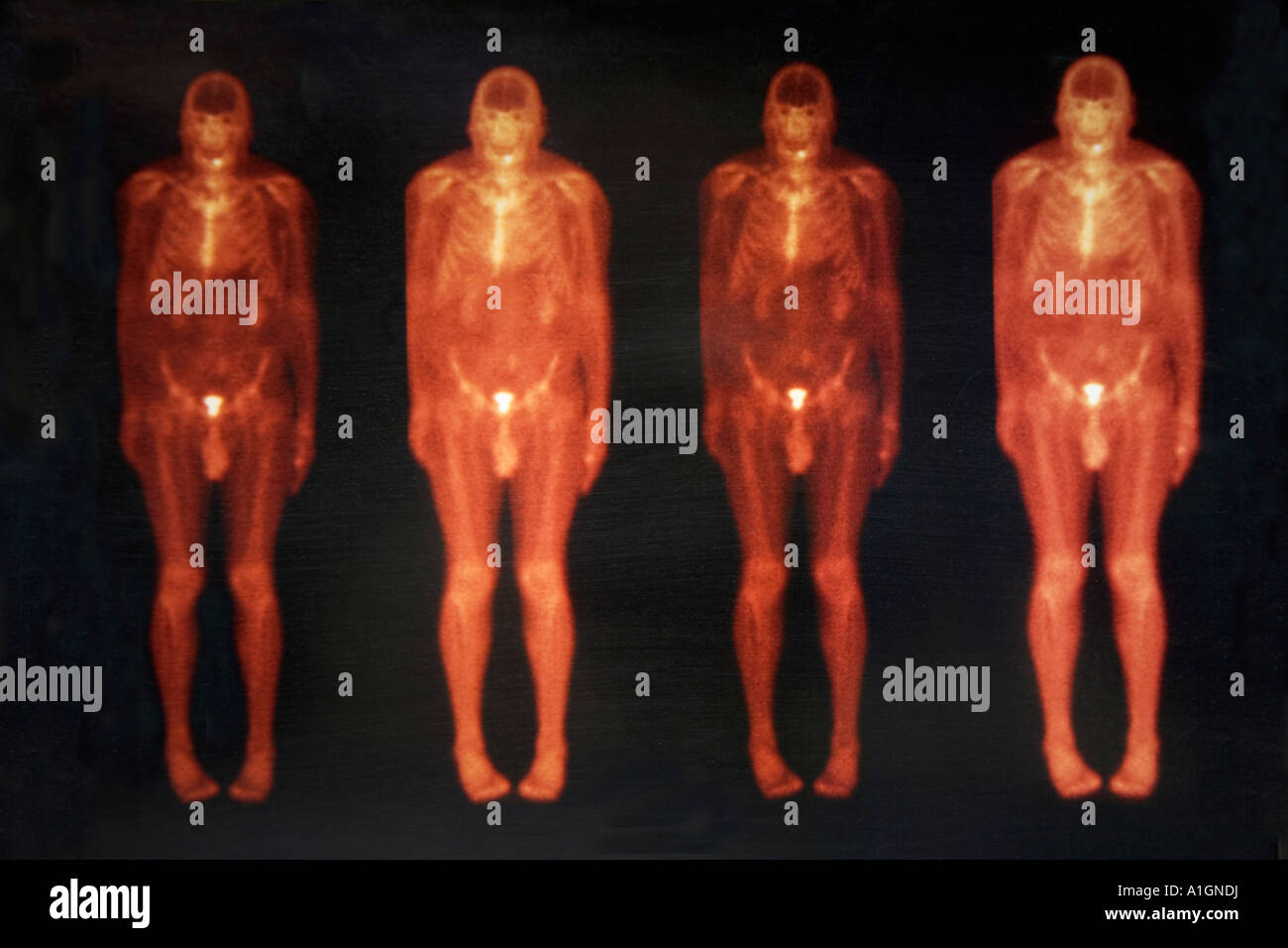 Ganzen Körper Technetium Bone Scan eines Mannes. Stockfoto