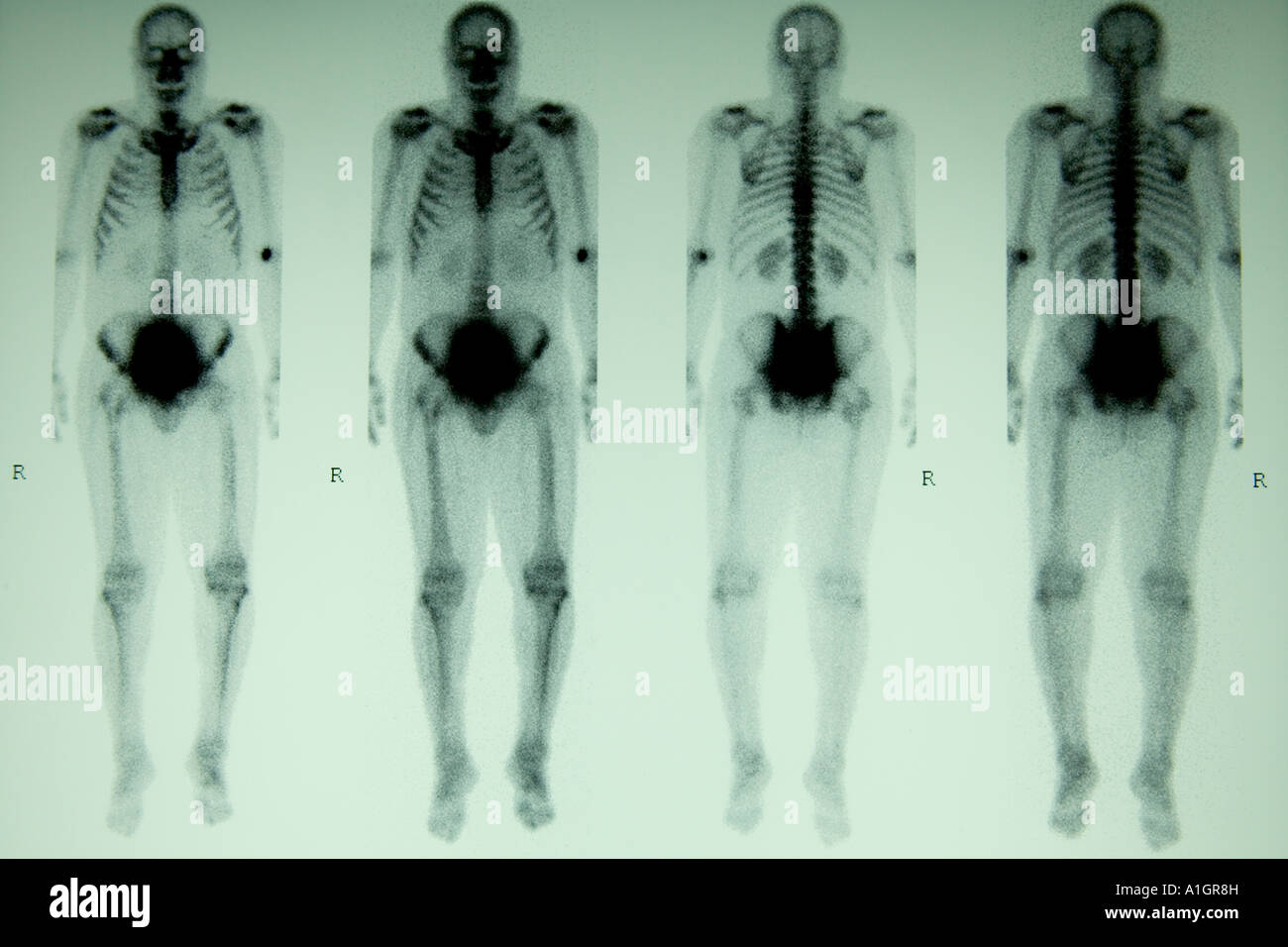 Nukleare Knochen-Scan, Ganzkörper 3-Phasen, Stockfoto