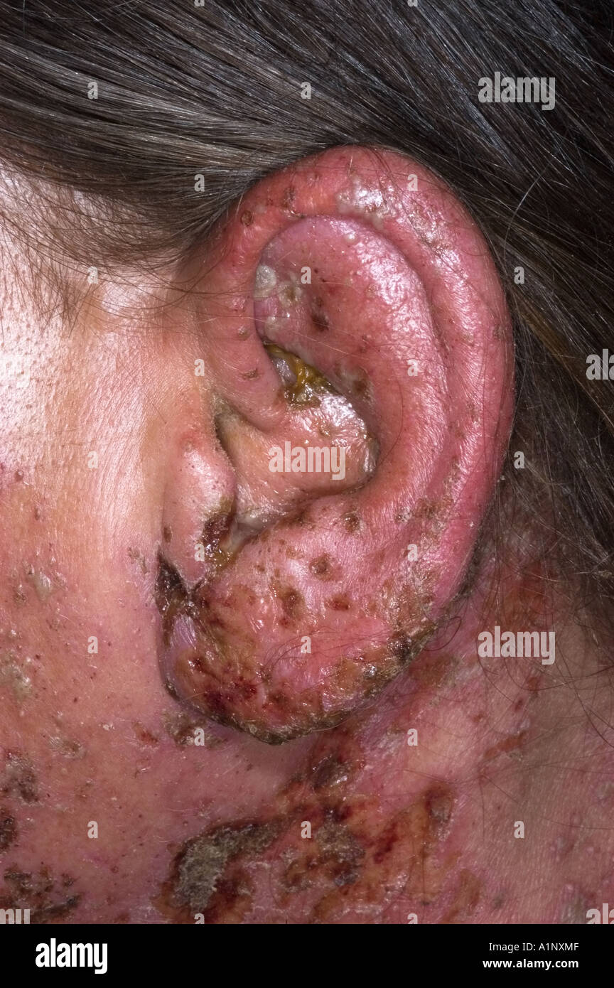 Herpes Zoster-Infektion von der linken Seite des Gesichts und der Ohren  Stockfotografie - Alamy
