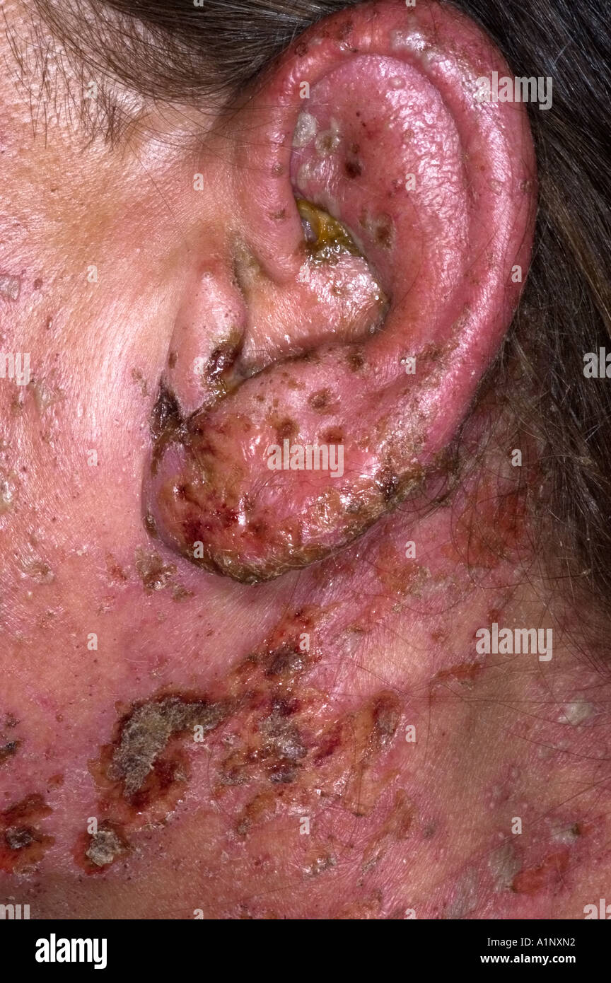 Herpes Zoster Virus Stockfotos &amp; Herpes Zoster Virus Bilder Seite 2