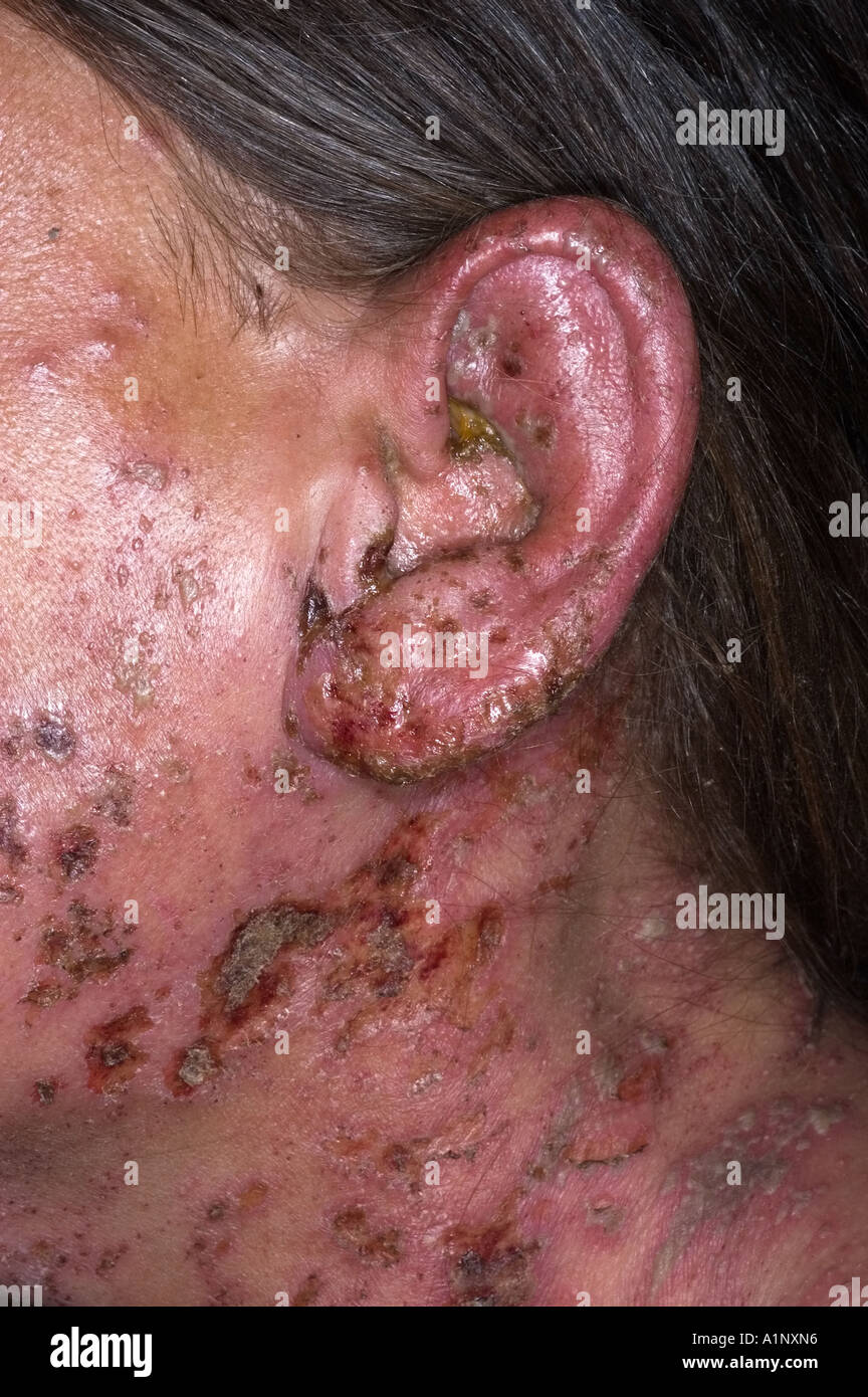 Herpes Zoster-Infektion von der linken Seite des Gesichts und der Ohren  Stockfotografie - Alamy