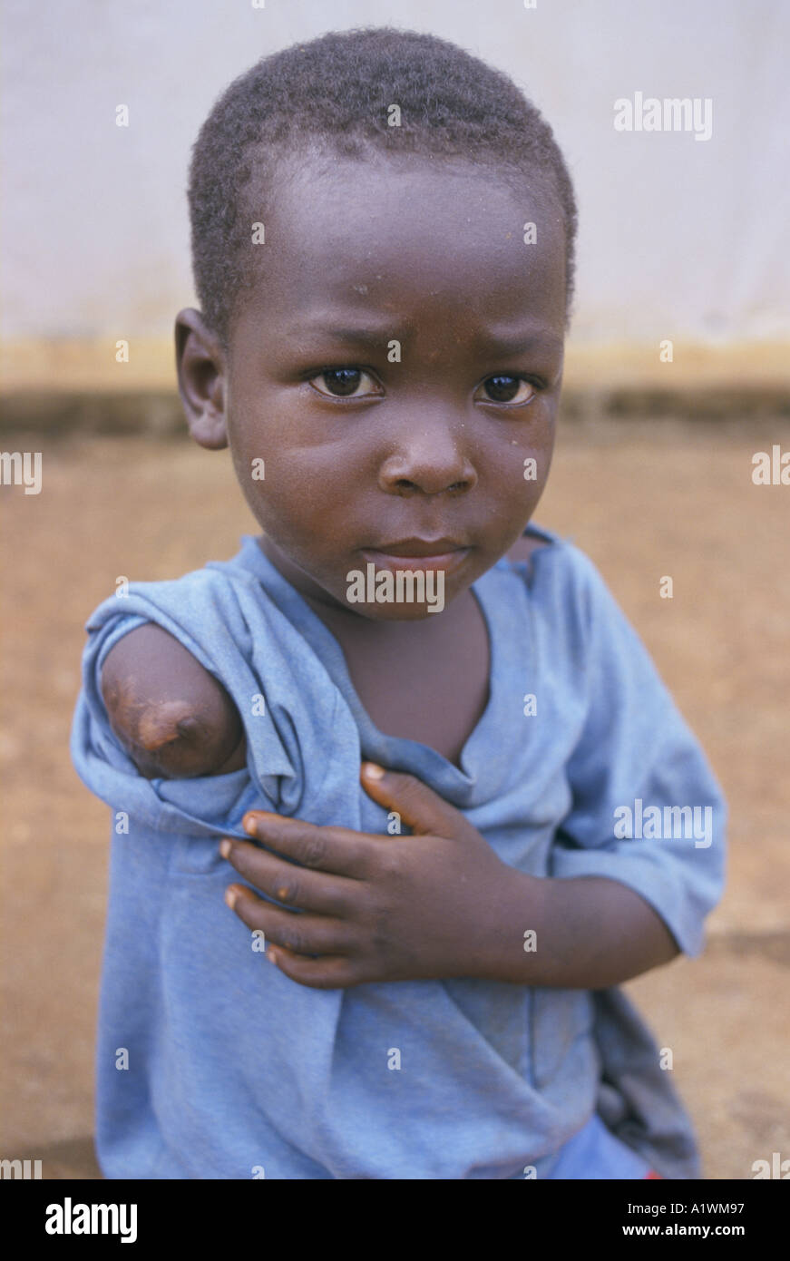 AMPUTIERTE SIERRA LEONE KIND MIT EINEM ARM AMPUTIERT BÖSWILLIG VON REBELLEN 1999 Stockfoto