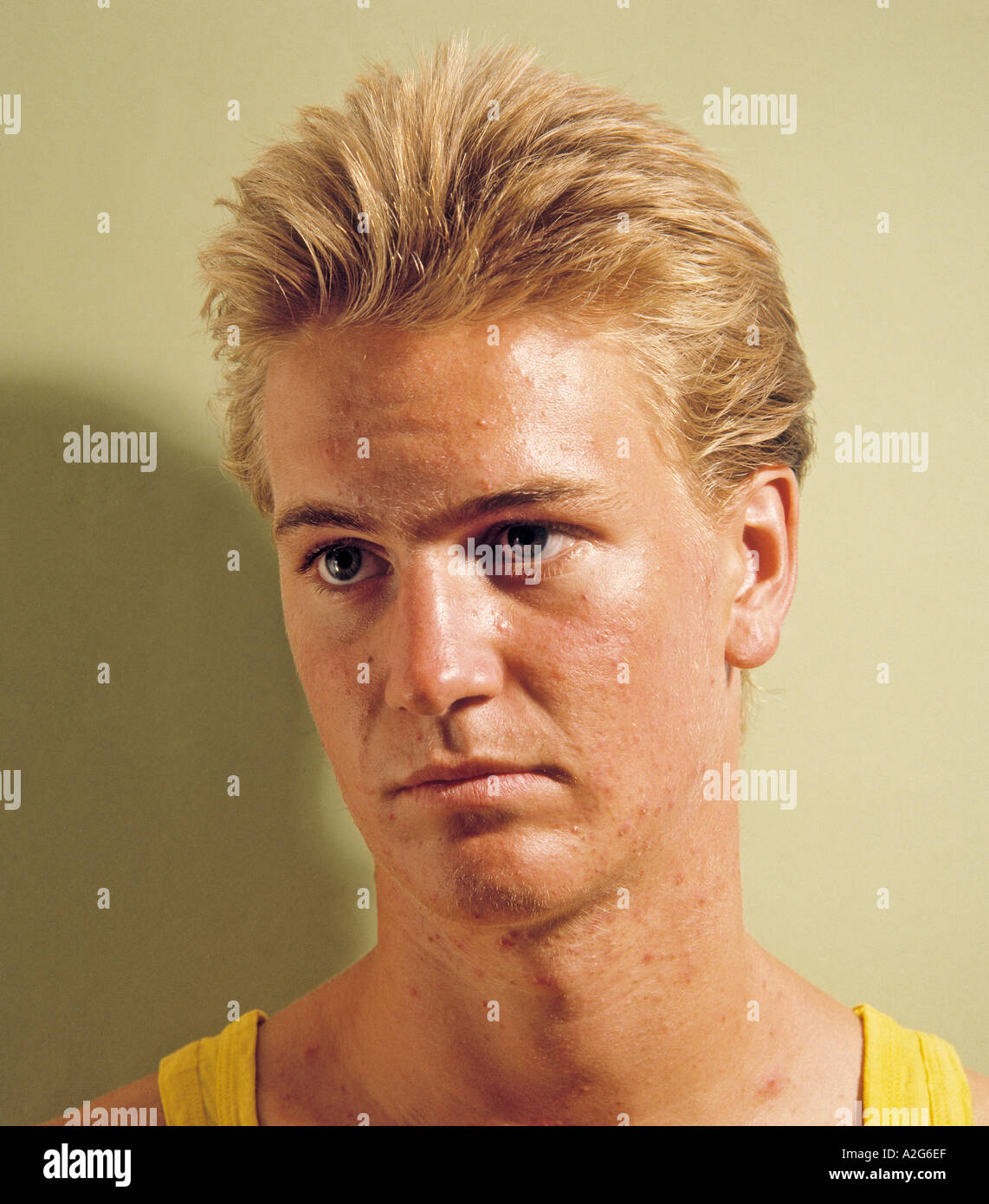 Jugendliche akne -Fotos und -Bildmaterial in hoher Auflösung – Alamy