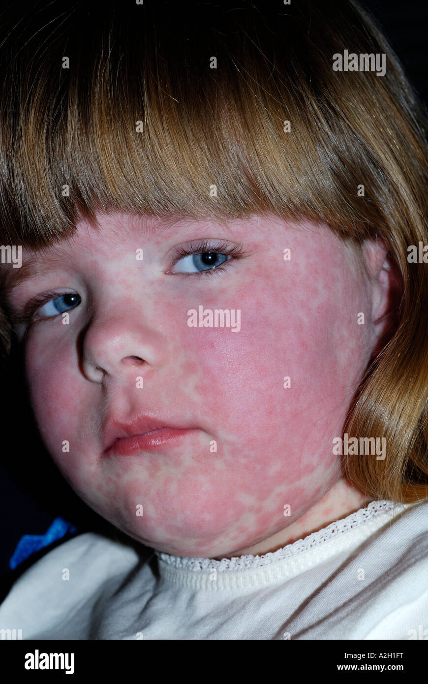 Amoxicillin Droge Ausschlag auf junge Mädchen Stockfoto