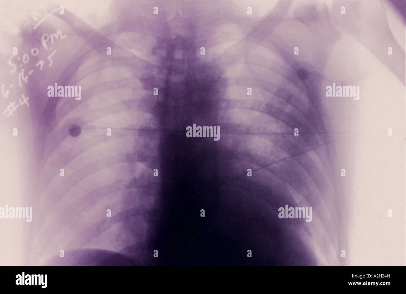 Progressive pestinfektion Fotos und Bildmaterial in hoher Auflösung