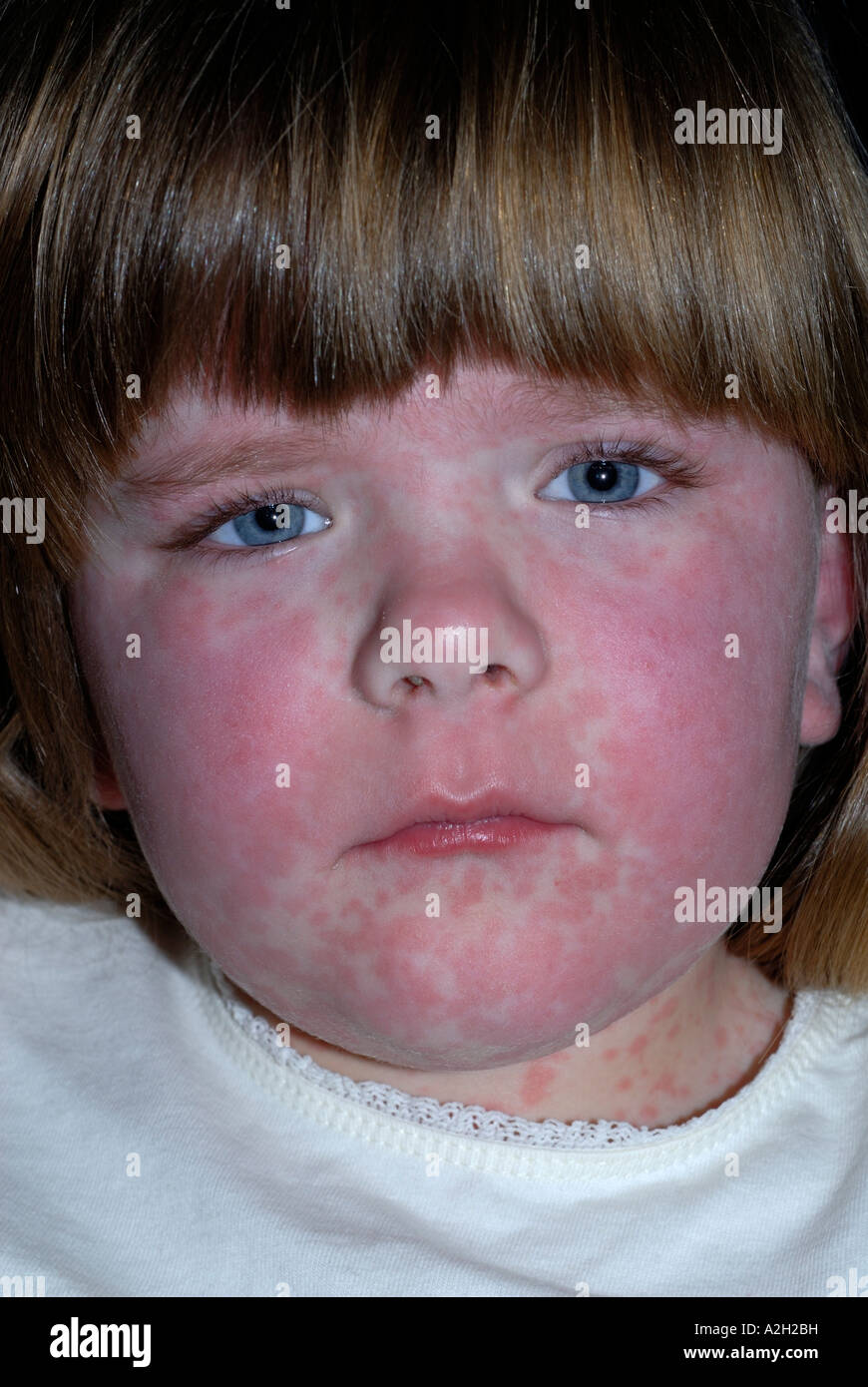 Amoxicillin Droge Ausschlag auf junge Mädchen Stockfoto