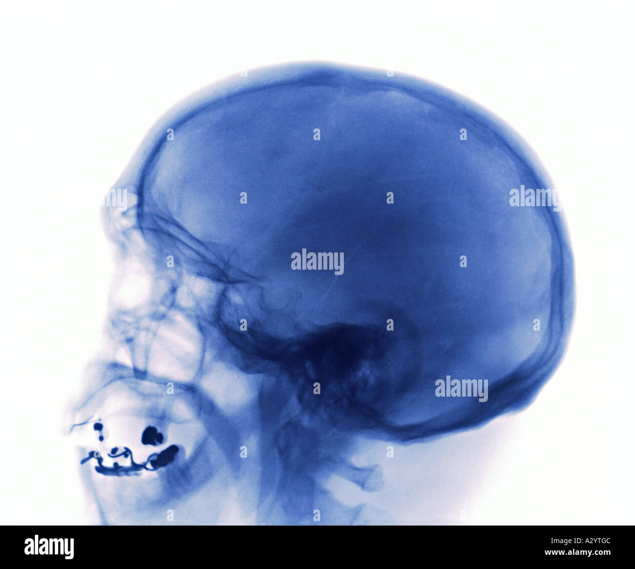 X-ray einen Schädelbruch Stockfoto