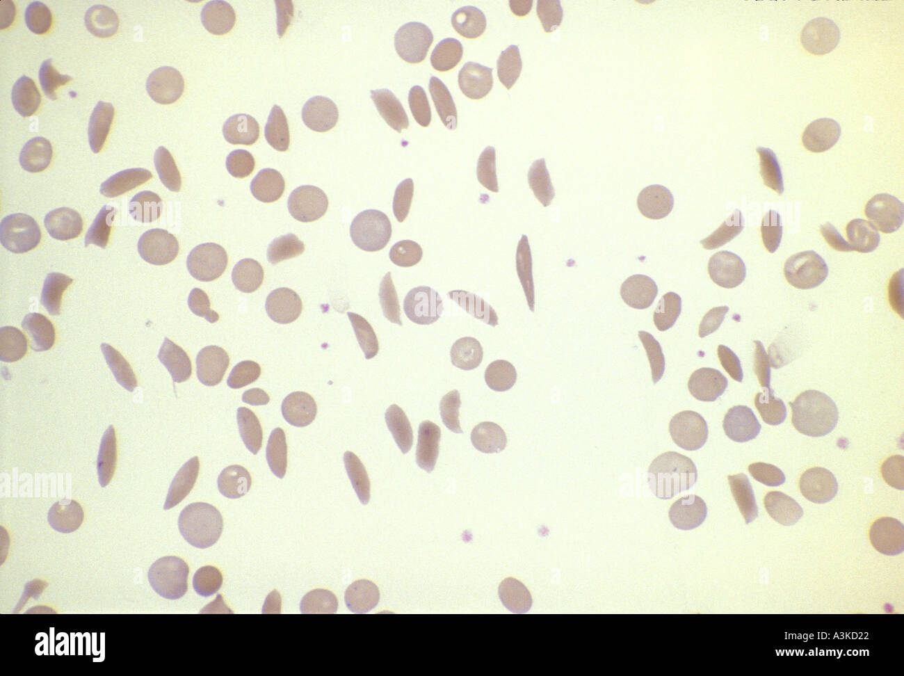 MEDIZINISCHE Blut & Sichelzell-Anämie Stockfoto