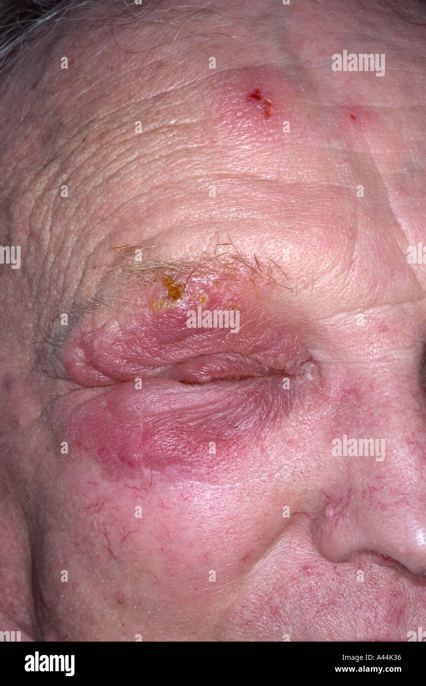 Herpes Zoster Gürtelrose Hautausschlag im Gesicht Stockfotografie Alamy