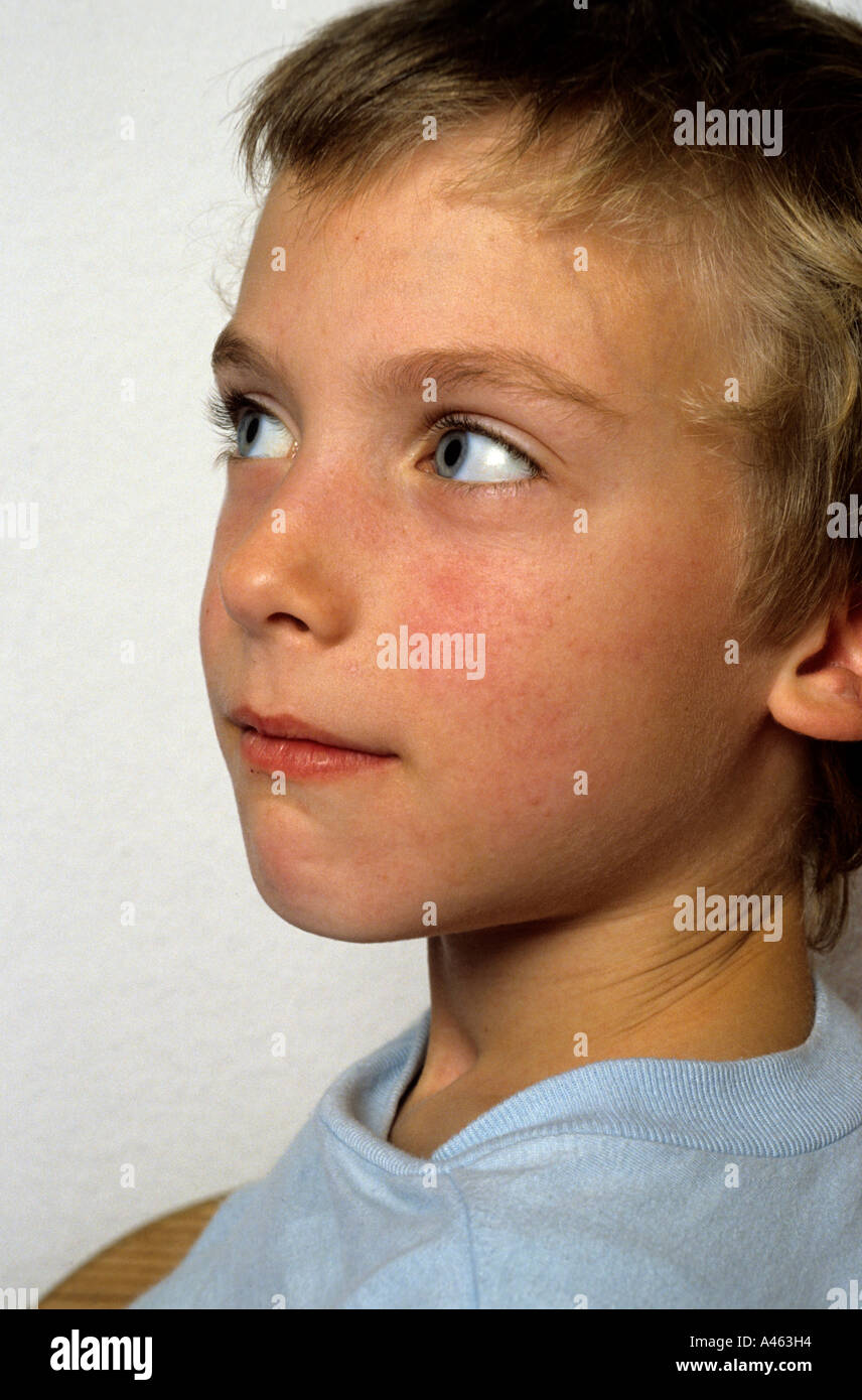 Kind mit Scharlach Stockfoto