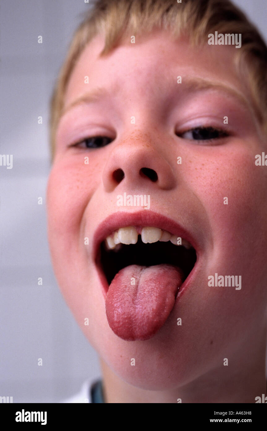 Kind mit Scharlach Stockfoto