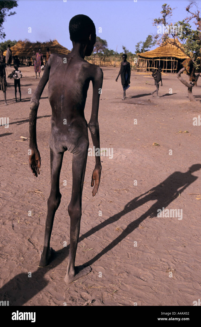 sudan food air drops ageip southern sudan severely malnourished man at medicin sans frontier feeding centre 1998 Stockfoto