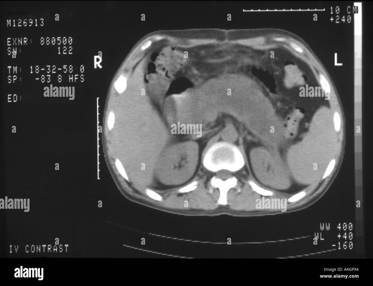 Dies ist ein CT-Scan eines Patienten mit einer akuten Pankreatitis. Stockfoto