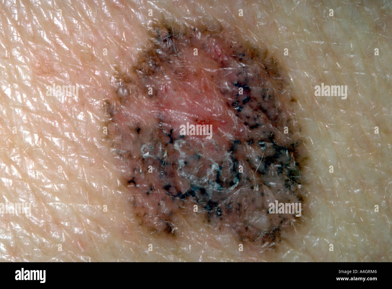 Basal Cell Carcinoma Stockfotos und bilder Kaufen Alamy