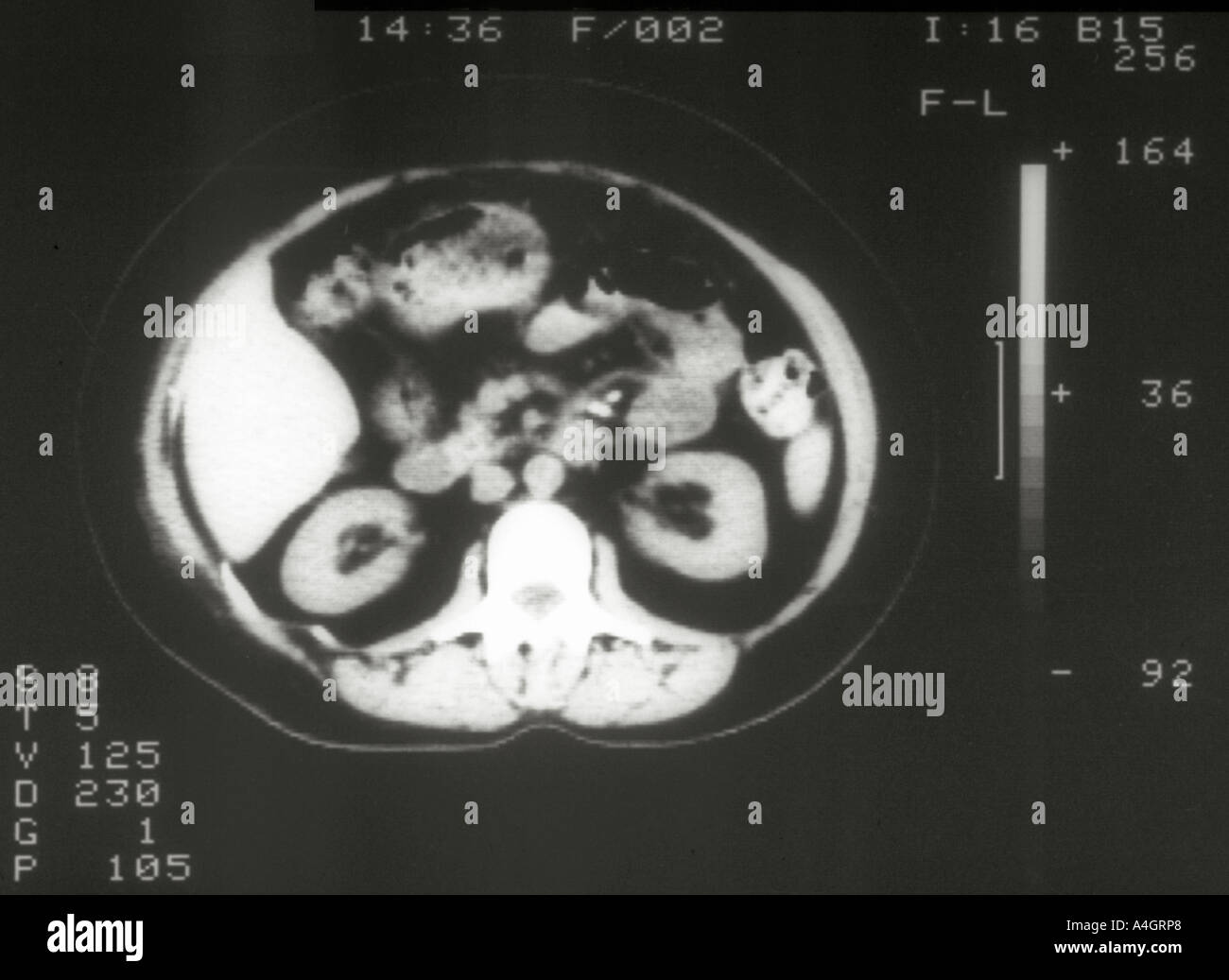 Ein CT-Scan durch den Unterleib von einem normalen Subjekt. Stockfoto