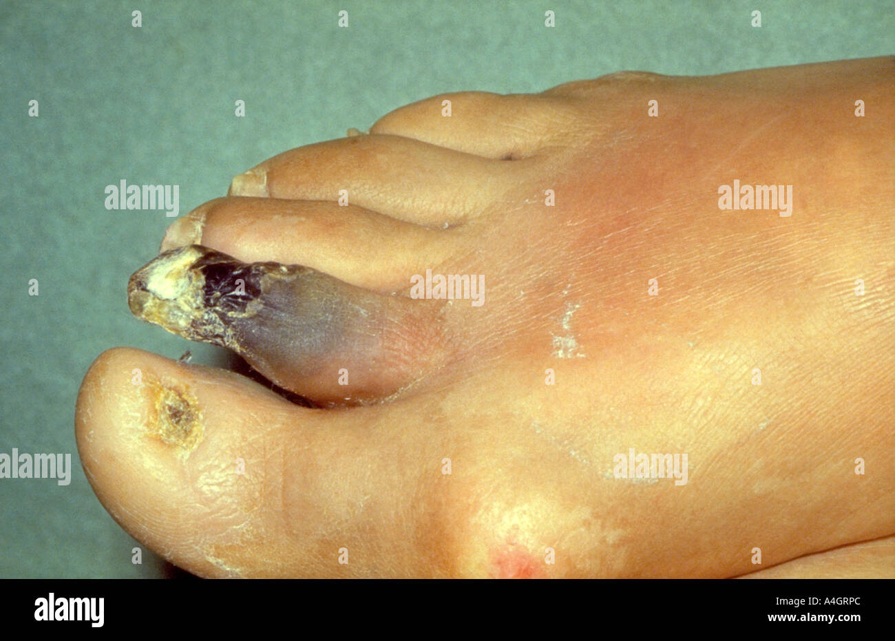 Gangrän ist Nekrose und Fäulnis der Gewebe, in der Regel an den Füßen durch Occulusive arteriellen Veränderungen Stockfoto