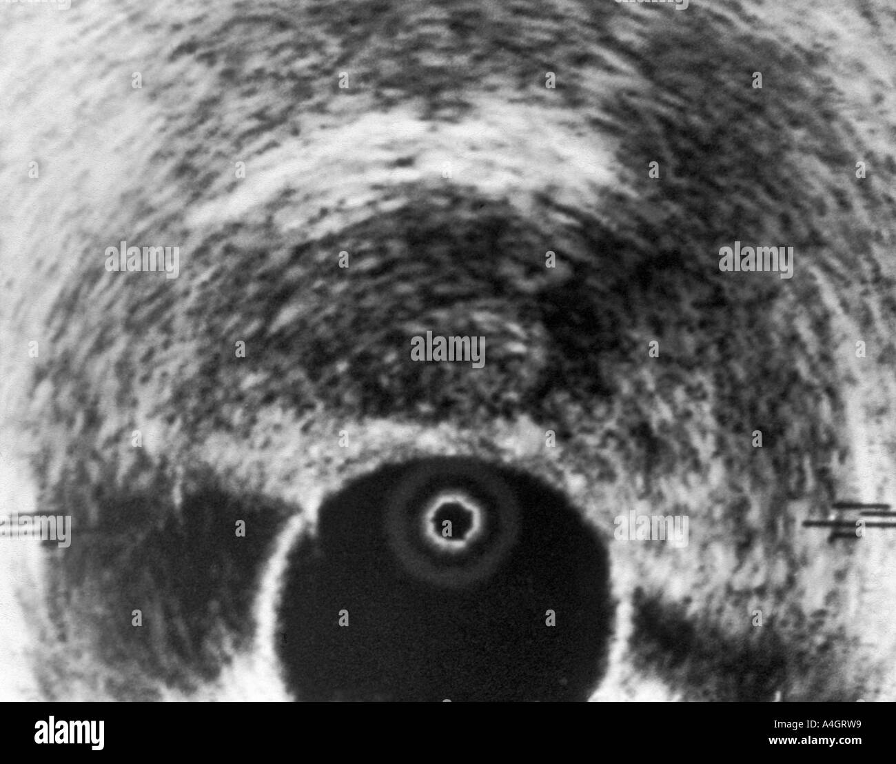 Eine transrektalen Ultraschall scan (TRUS) der Prostata Prostatakrebs zeigen. Stockfoto