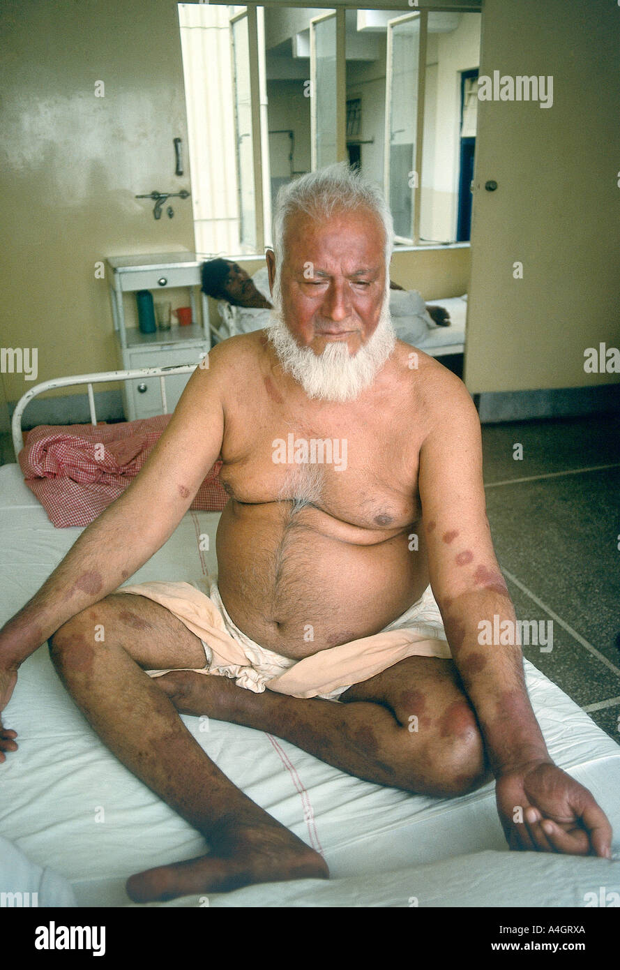 Ein Foto von einem Mann mit Lepra in Pakistan. Stockfoto