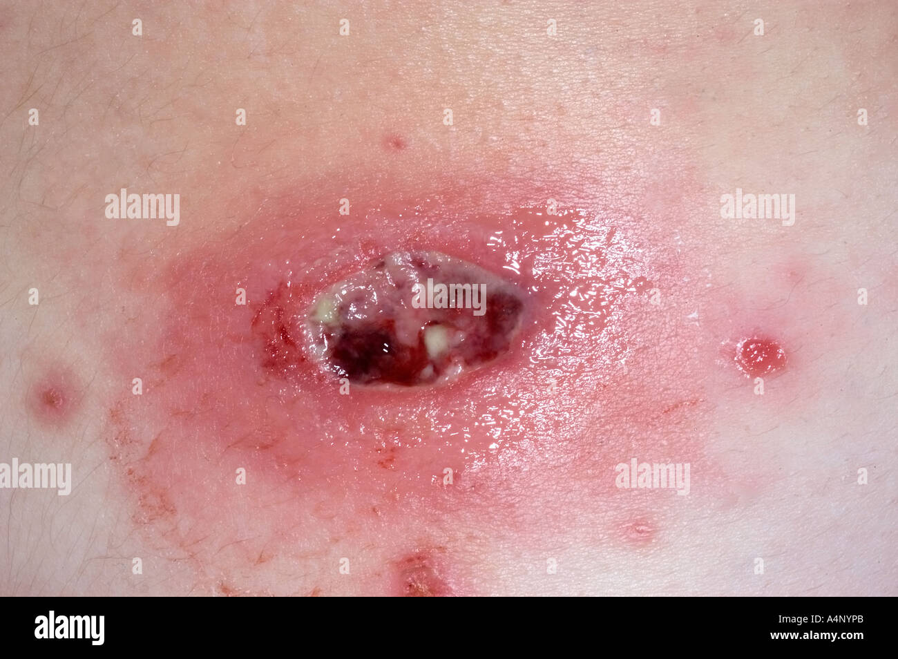 Methicillin-resistenten Staph Aureus Hautinfektion Stockfoto