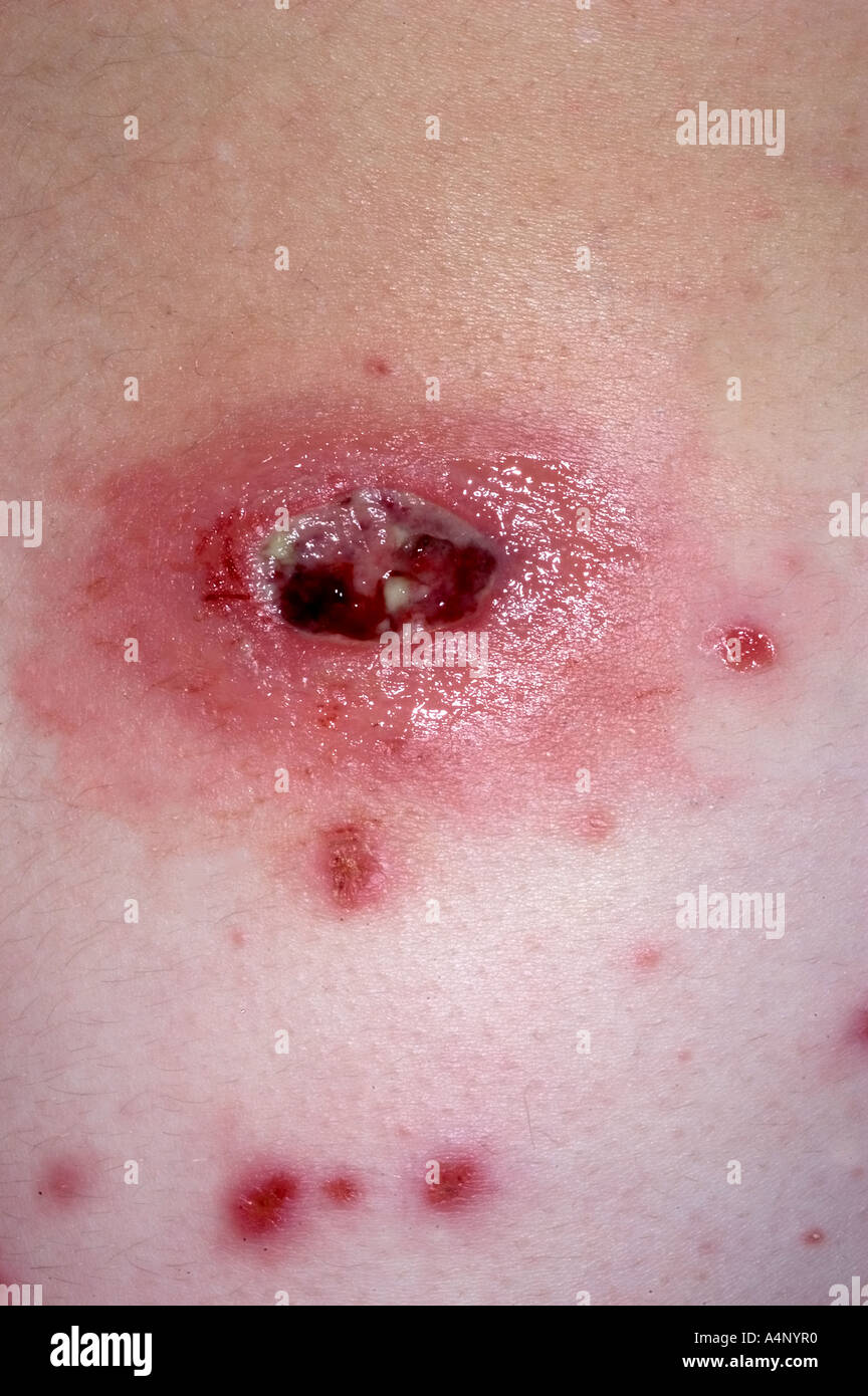 Methicillin-resistenten Staph Aureus Hautinfektion Stockfoto