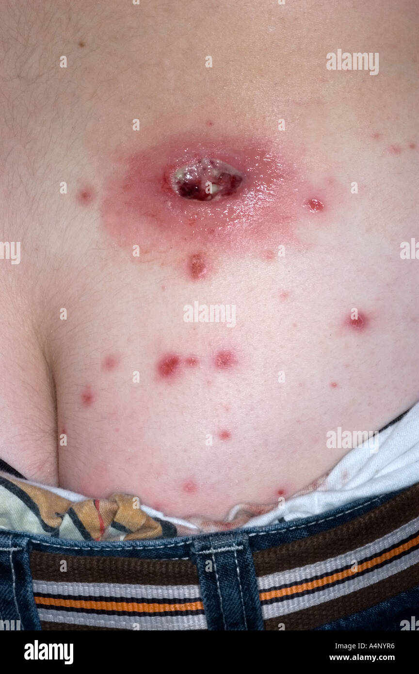 Methicillin-resistenten Staph Aureus Hautinfektion Stockfoto