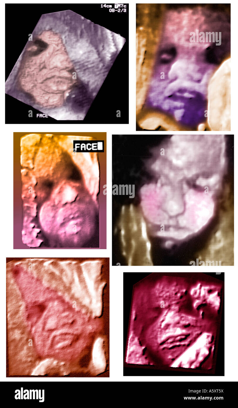 3D Ultraschall menschlichen Fötus im Uterus der Mutter Stockfoto