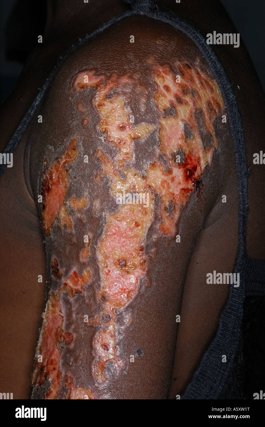 Unidentified Blasenbildung Läsionen auf dem Arm von einem nigerianischen Mädchen Stockfoto