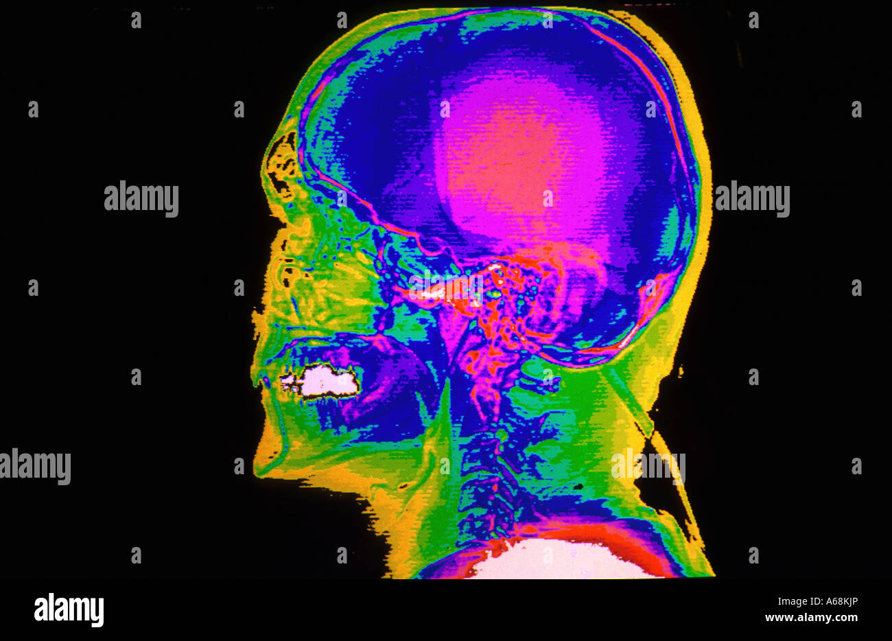 Farbe-CAT-Scan der lateralen Schädelbasis Stockfoto