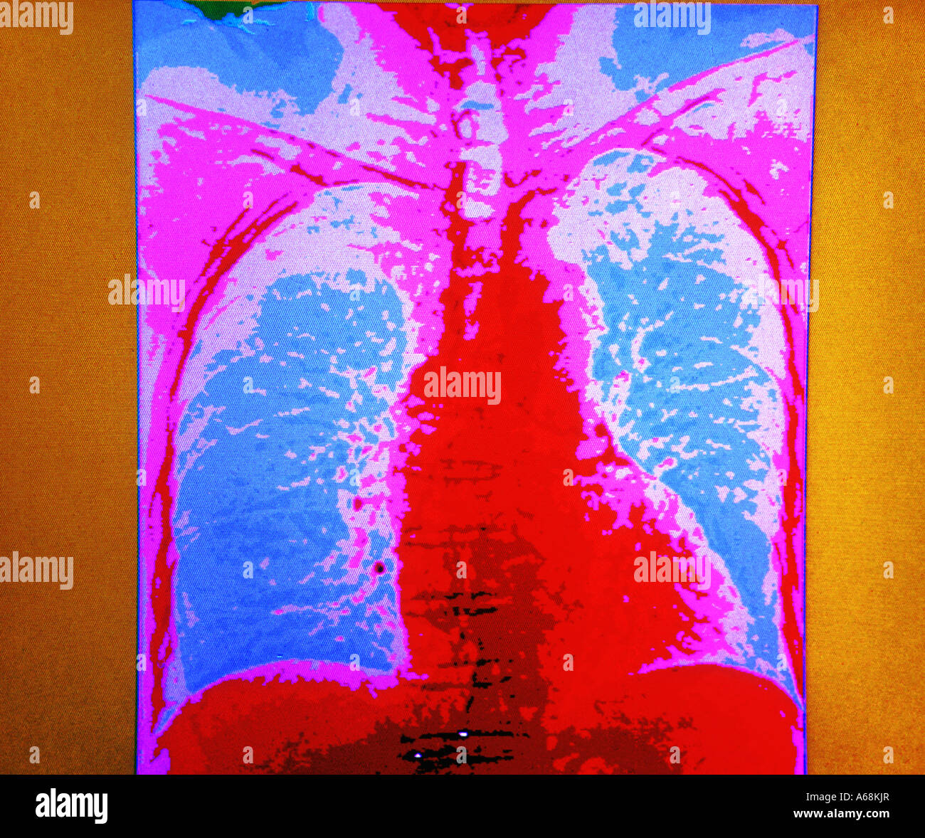 Cat-Scan von Brust und Lunge Stockfoto