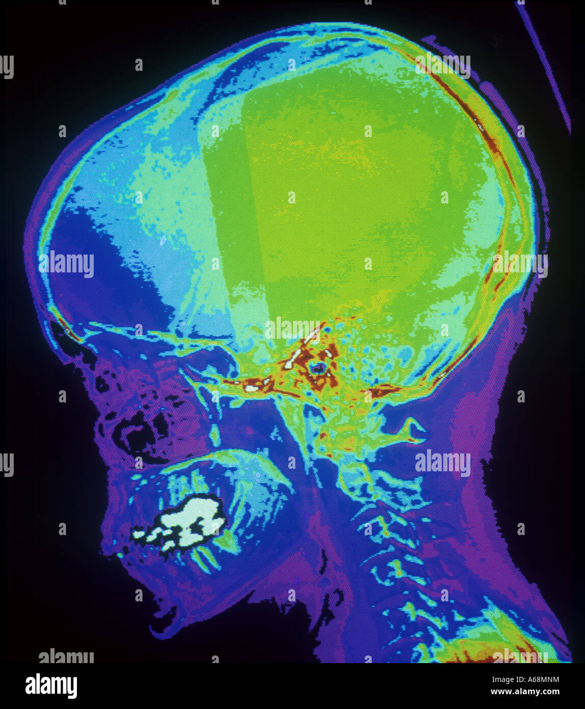 Farbe-CAT-Scan der lateralen Schädelbasis Stockfoto