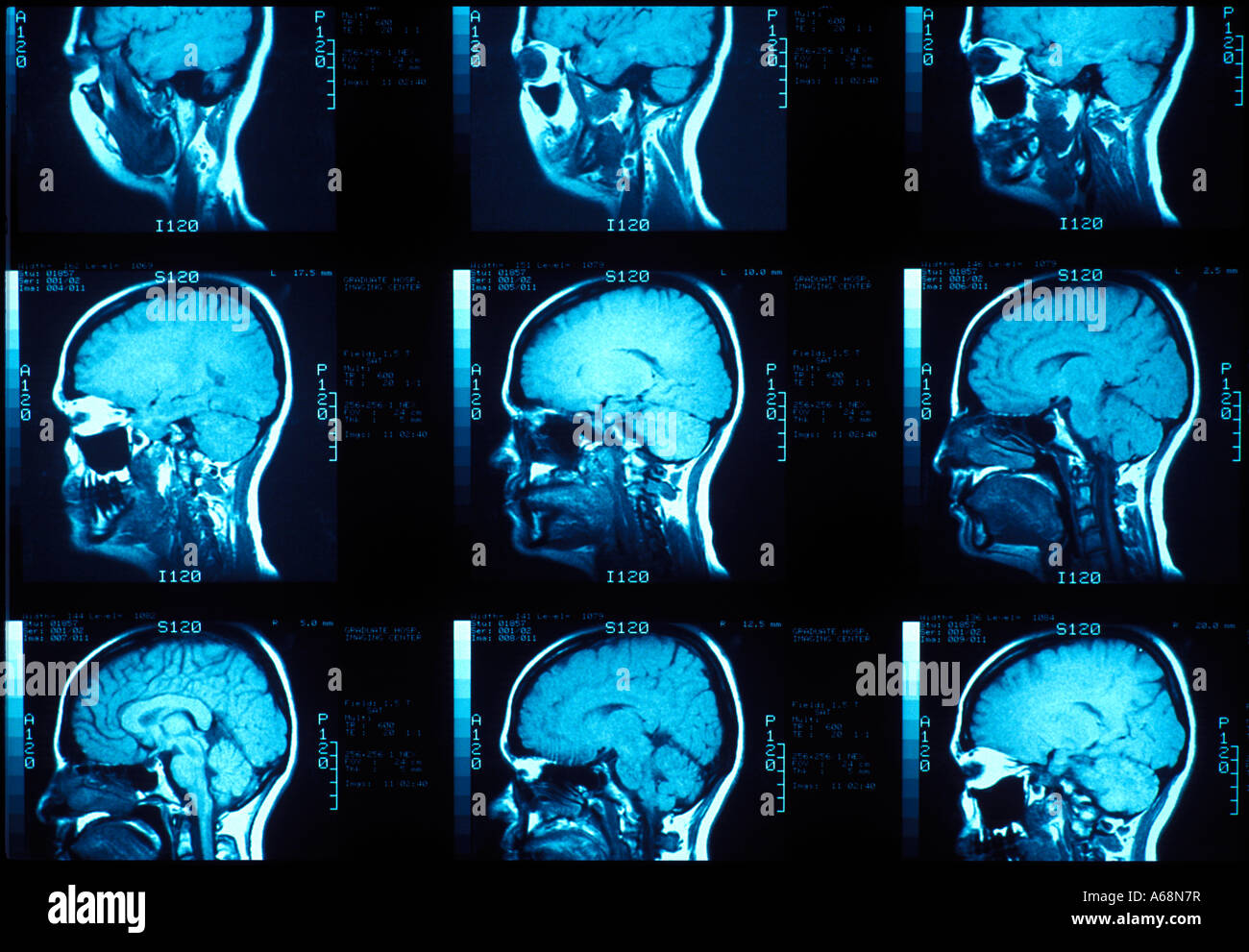 MRT der lateralen Schädelbasis Stockfoto