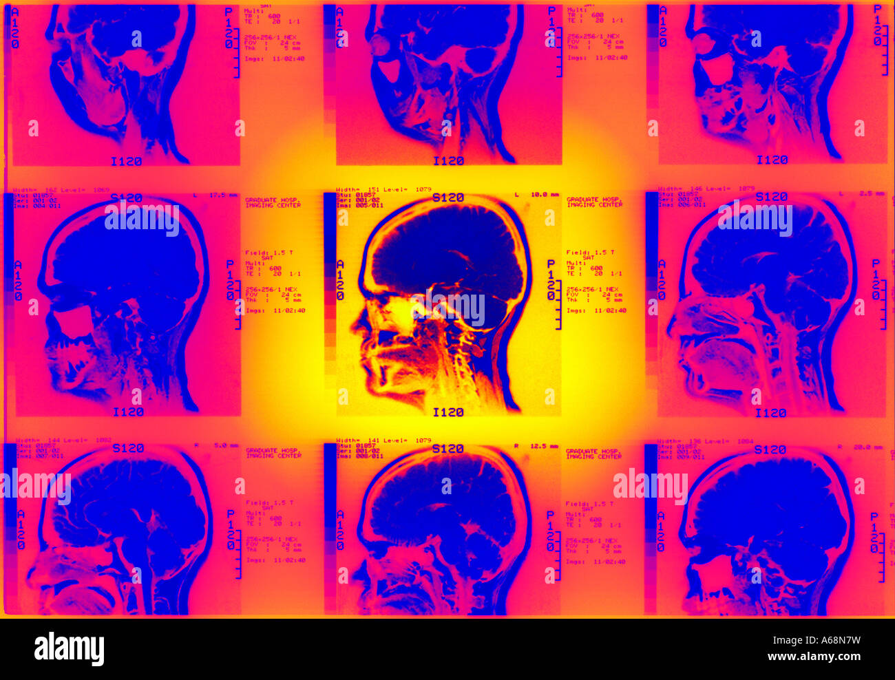 MRT der lateralen Schädelbasis Stockfoto