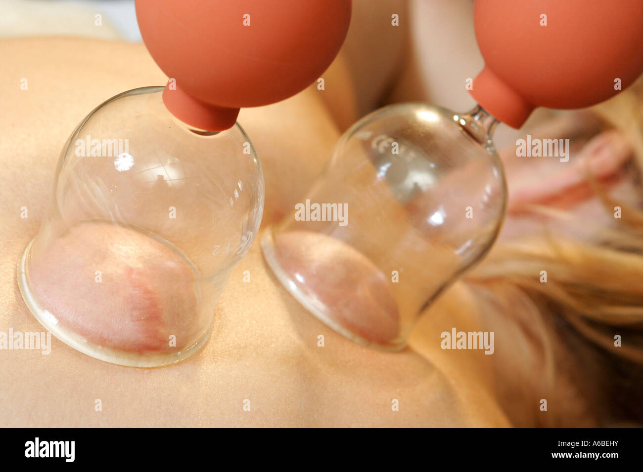 Alternative Therapie mit Vakuum Banken Stockfoto