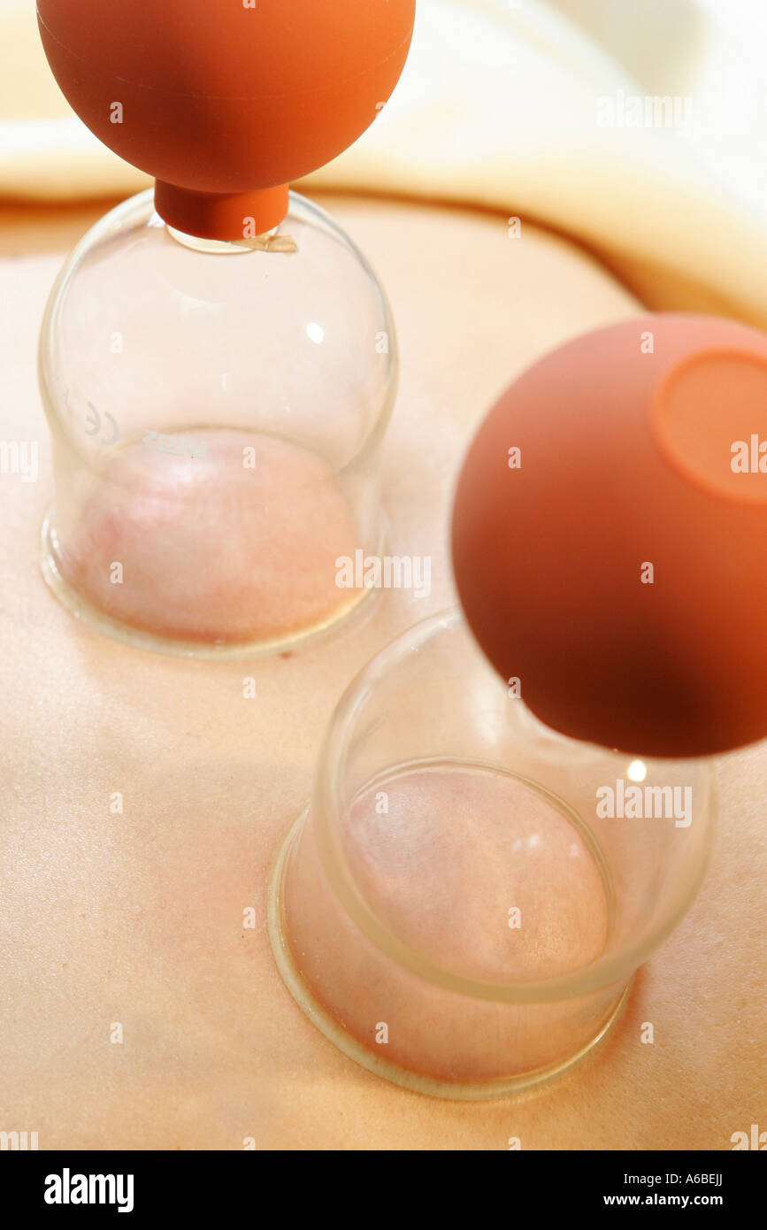 Alternative Therapie mit Vakuum Banken Stockfoto