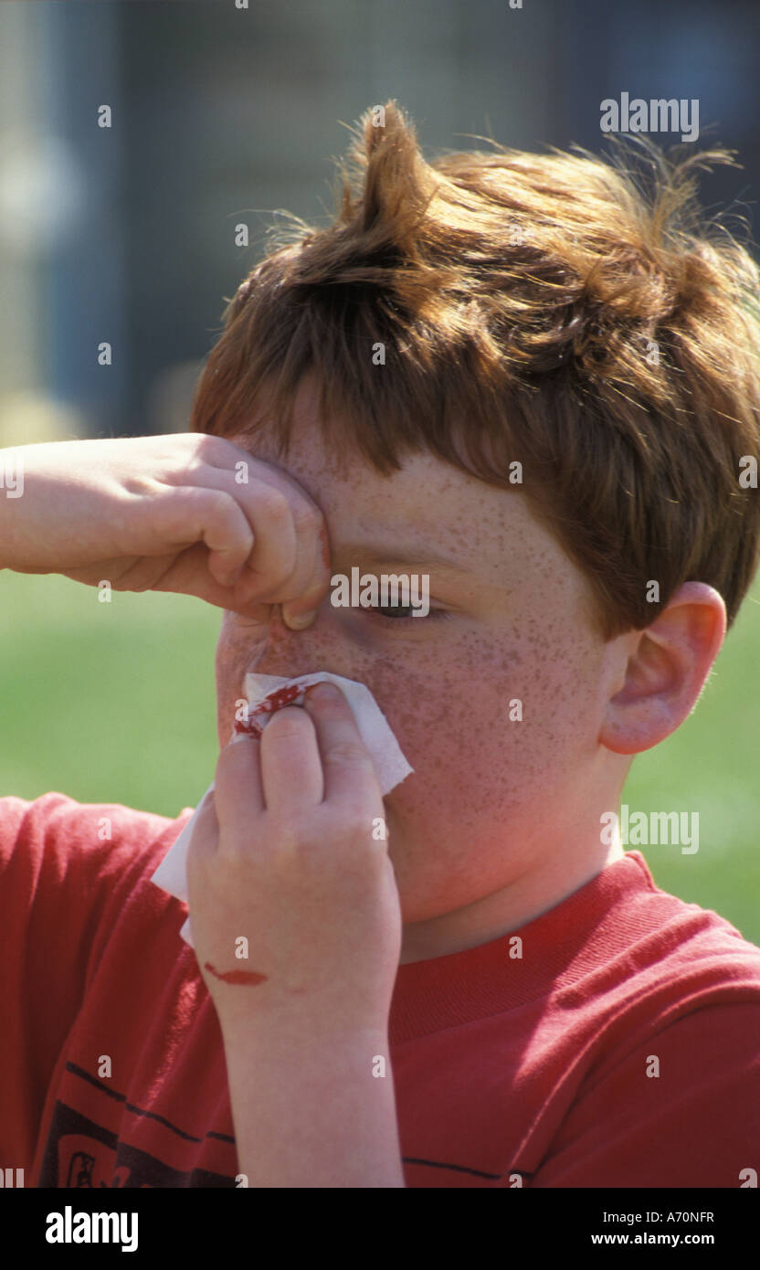 Junge mit Nasenbluten Stockfoto
