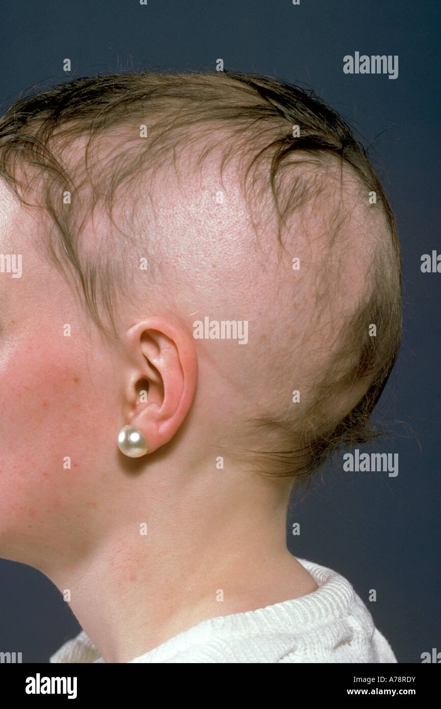 ALOPECIA AREATA Stockfoto