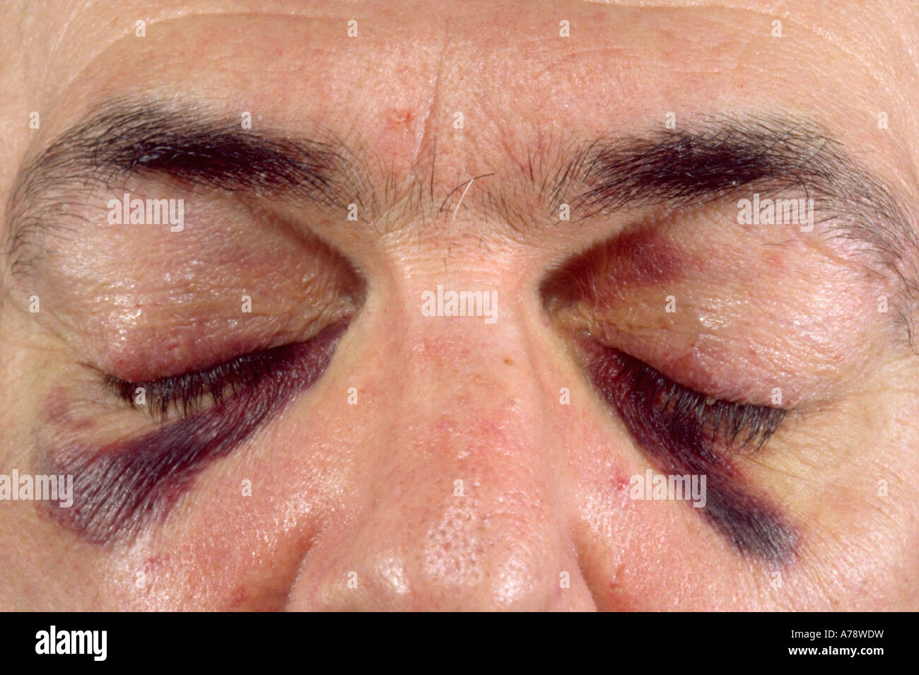 Ein Thema Mit Thrombozytopenie Eine Verringerung Der Zahl Der Blutplattchen Im Blut Stockfotografie Alamy
