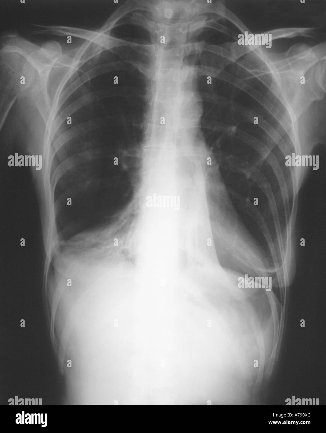 Eine Brust Röntgen zeigt Kollaps der rechten und linken unteren Lappen der Lunge Stockfoto
