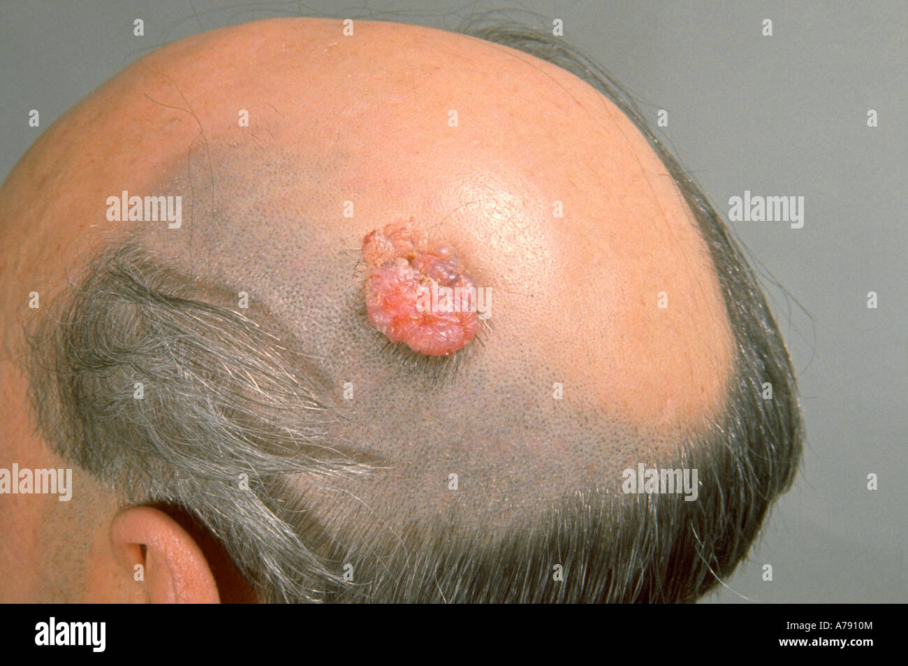 Squamous Zelle Krebsgeschwür SCC Stockfoto