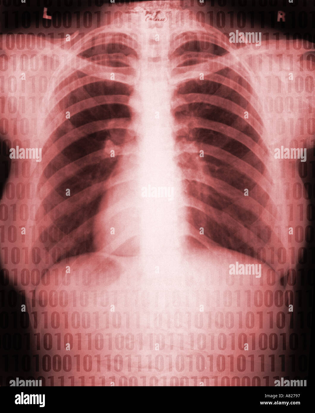 Brust-Xray mit Einsen und Nullen Stockfoto