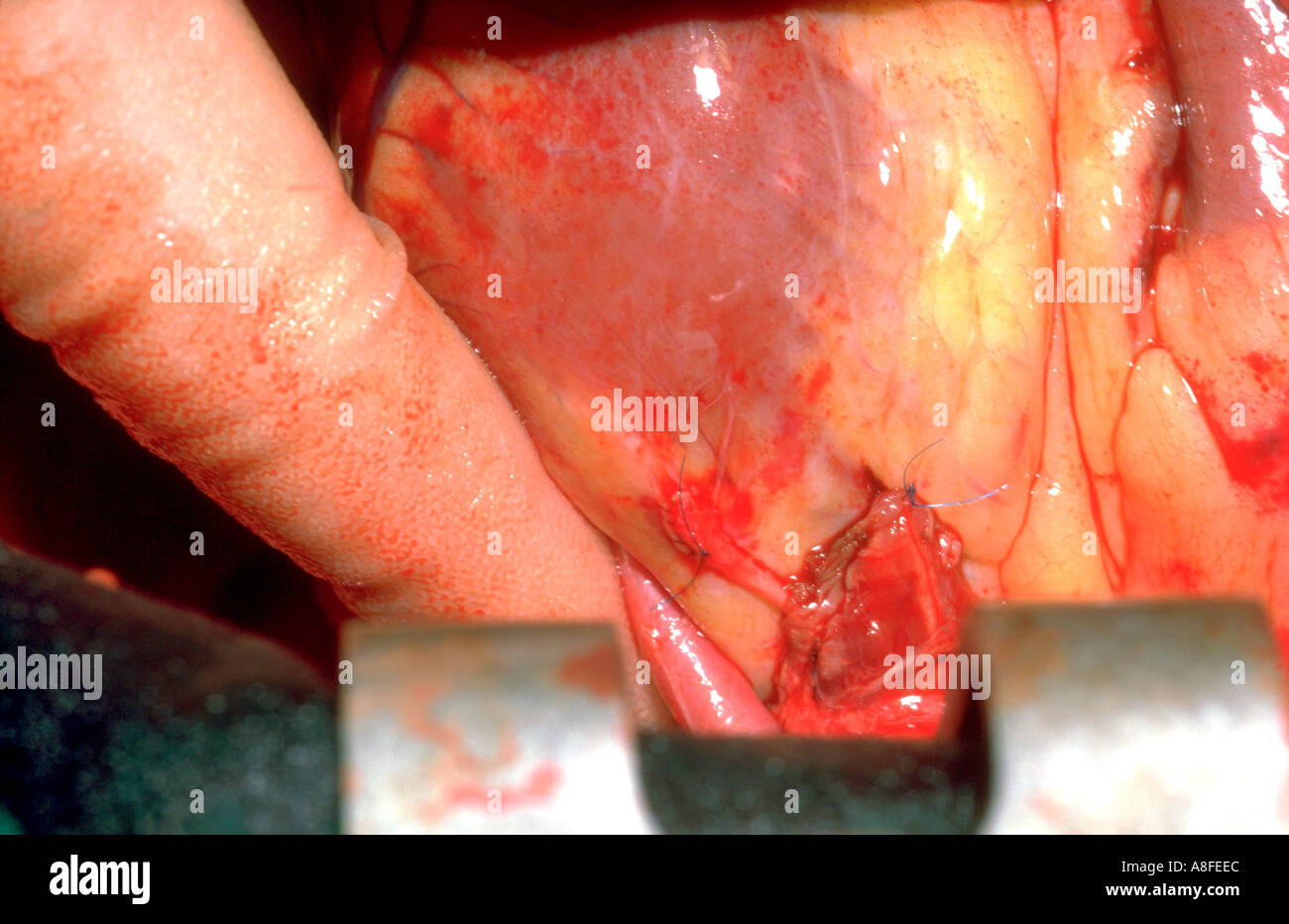 Coronary Artery Bypass Graft Betrieb Stockfoto