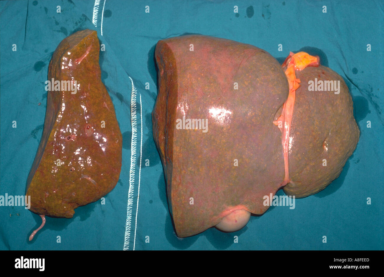 Leber Probe Hepatitis C Stockfotografie Alamy Leber Probe Hepatitis C Stockfotografie Alamy