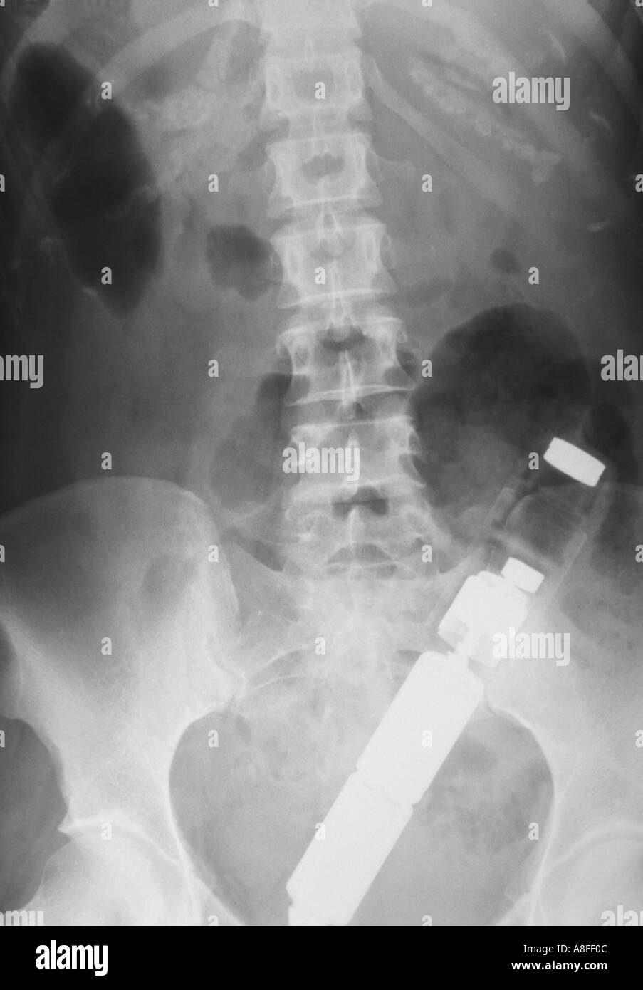 dildo im darm Fremdkörper-Vibrator im Rektum Stockfotografie
