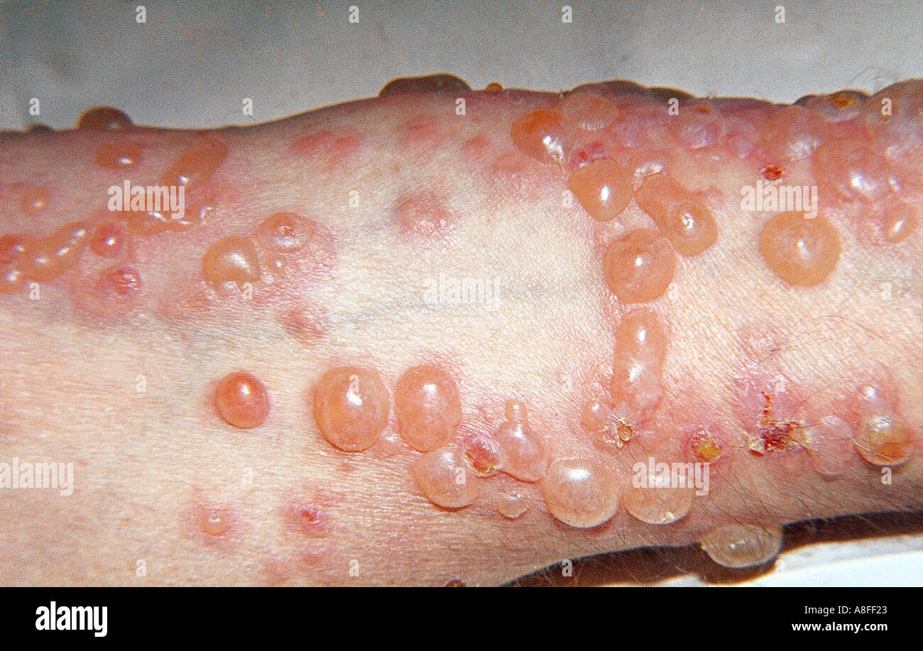 Erythema multiforme Stockfoto, Bild 589603 Alamy