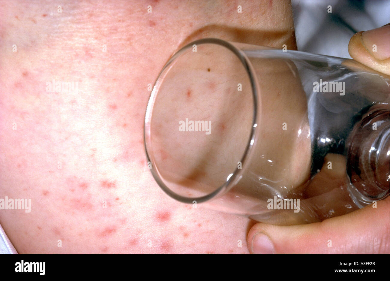 Prüfung von Meningokokken Ausschlag Stockfoto