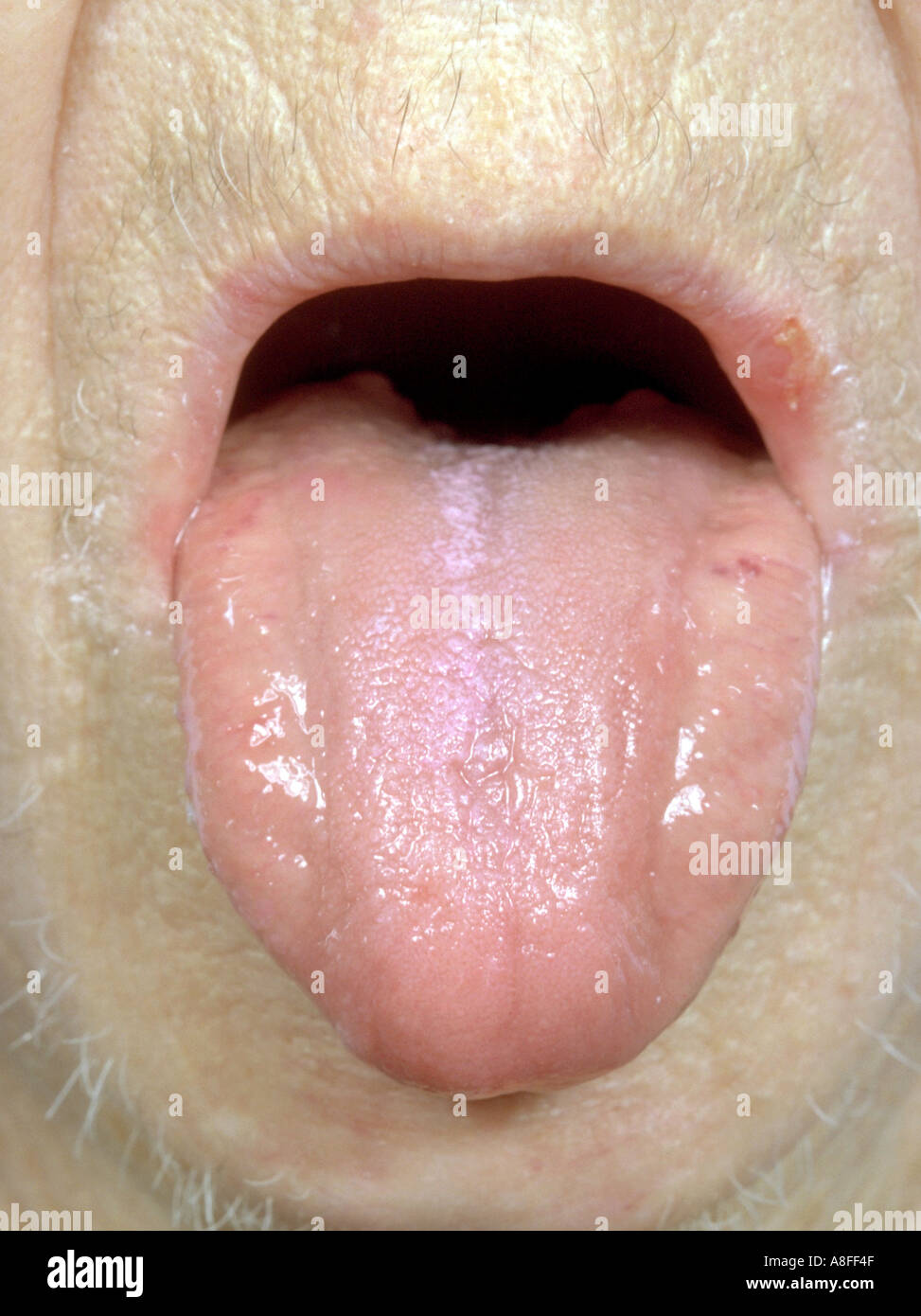 Perniziöse Anämie Stockfoto