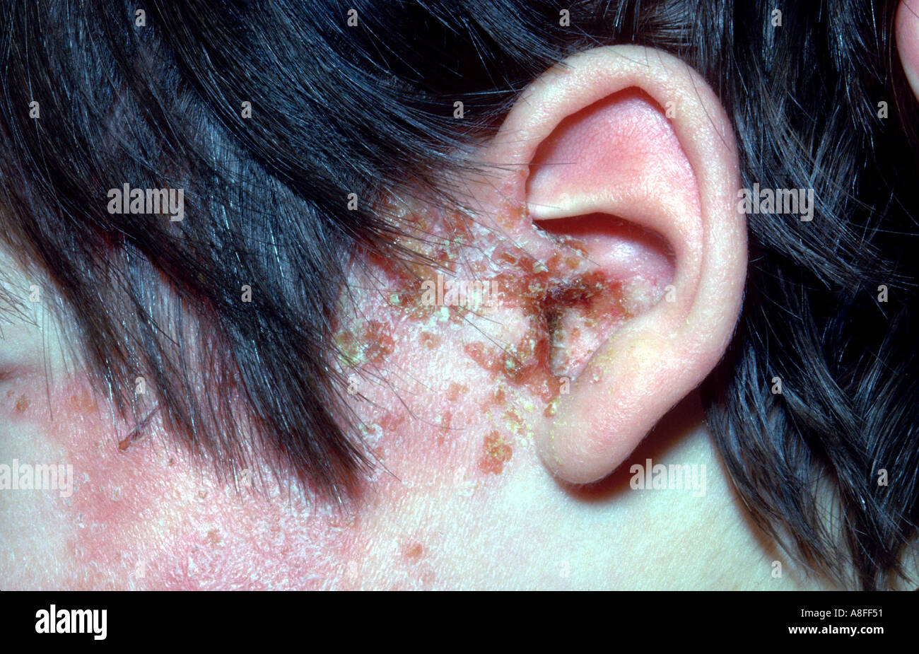 Herpes Zoster Virus Stockfotos &amp; Herpes Zoster Virus Bilder Seite 2